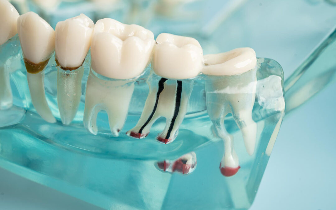 Root Canal Therapy: Signs You Need Treatment and What to Expect