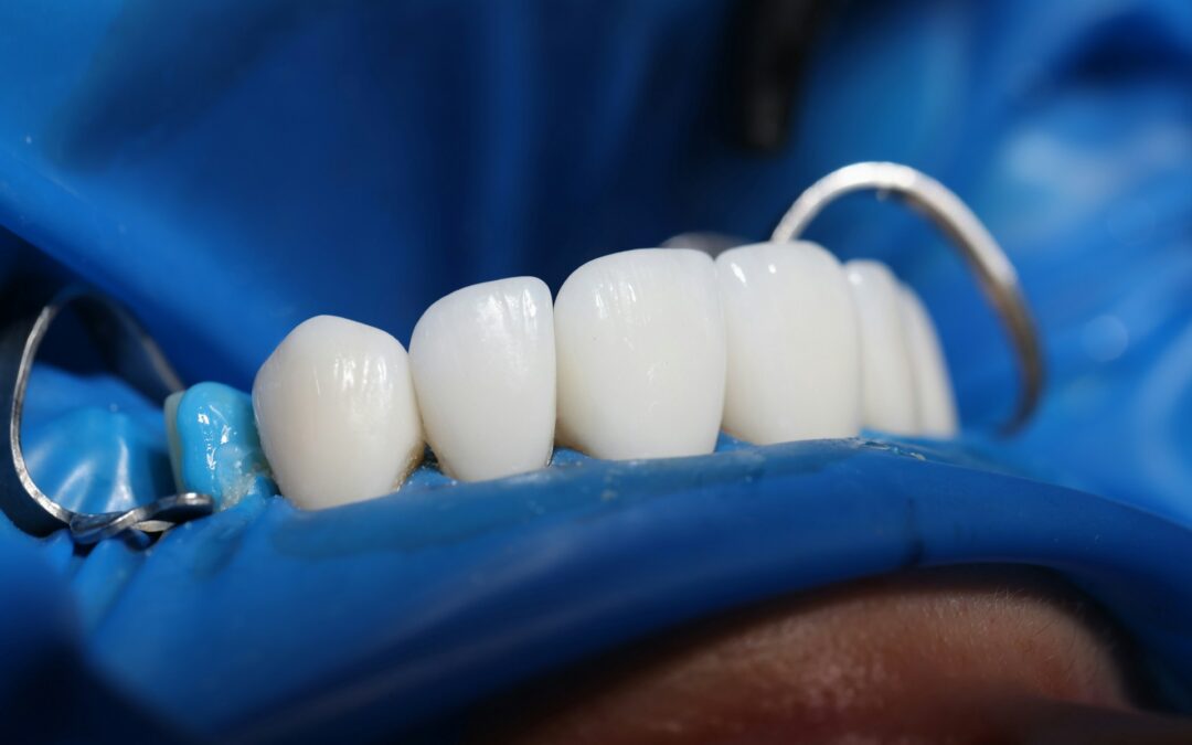 Advantages of Porcelain Veneers for a Perfect Smile