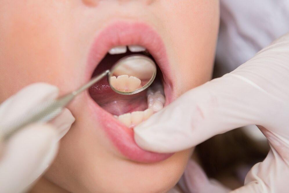 How to Make Tooth-Colored Fillings Last Longer